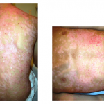 Initial Condition - Psoriasis